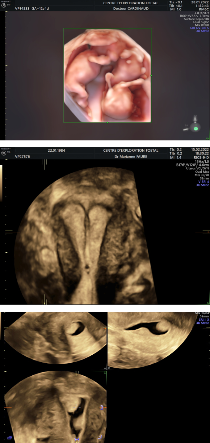 bébé échographie triple sonogramme grossesse cadre pour les